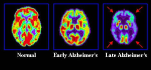 Images Of The Human Mind Effected By Alzheimers